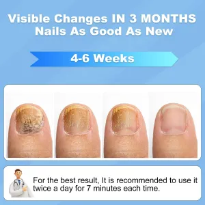 Nail Fungus Laser Treatment Device -Pain-Free, and Effective Home Treatment, No More Embarrassment